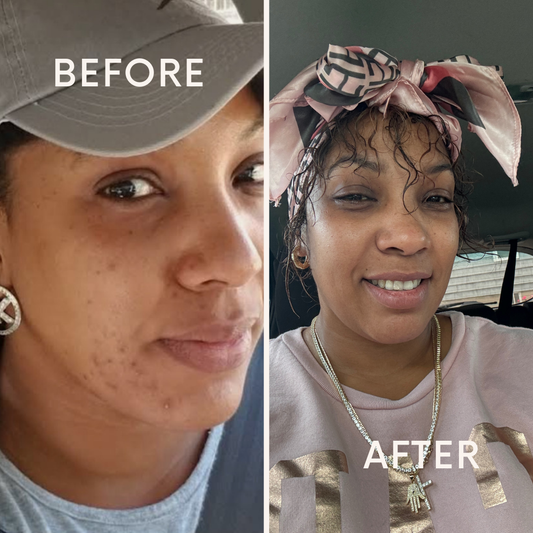 🌸 Anti-Dark Spots & Acne Combo 🌸
