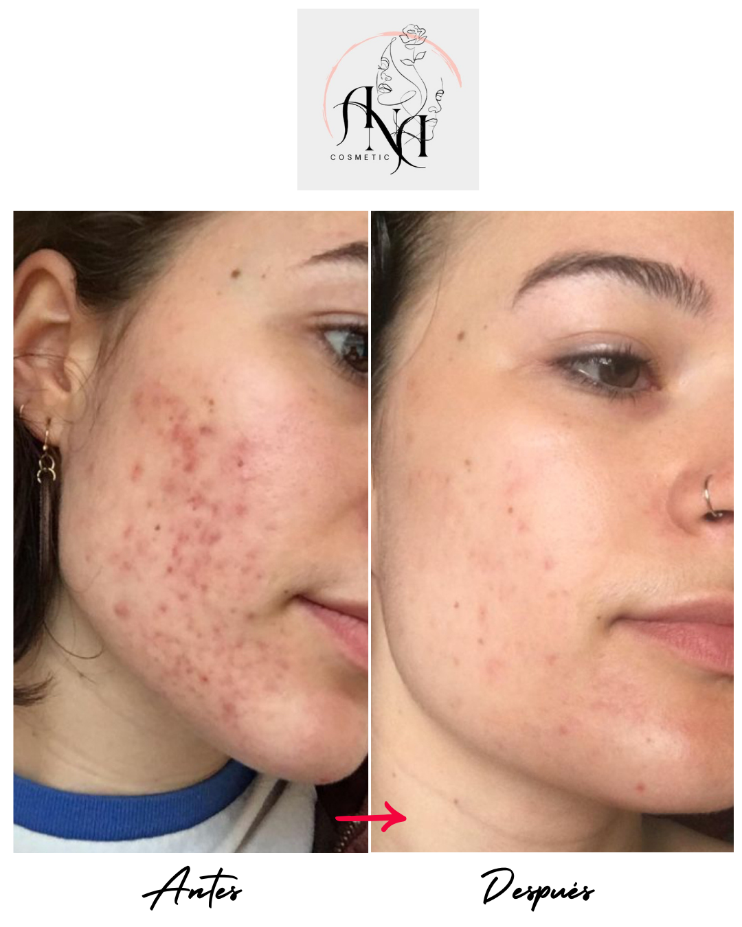🌸 Anti-Dark Spots & Acne Combo 🌸